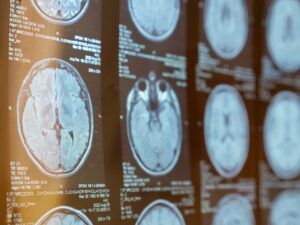 How Do I Prove a Brain Injury Legally in Louisiana?